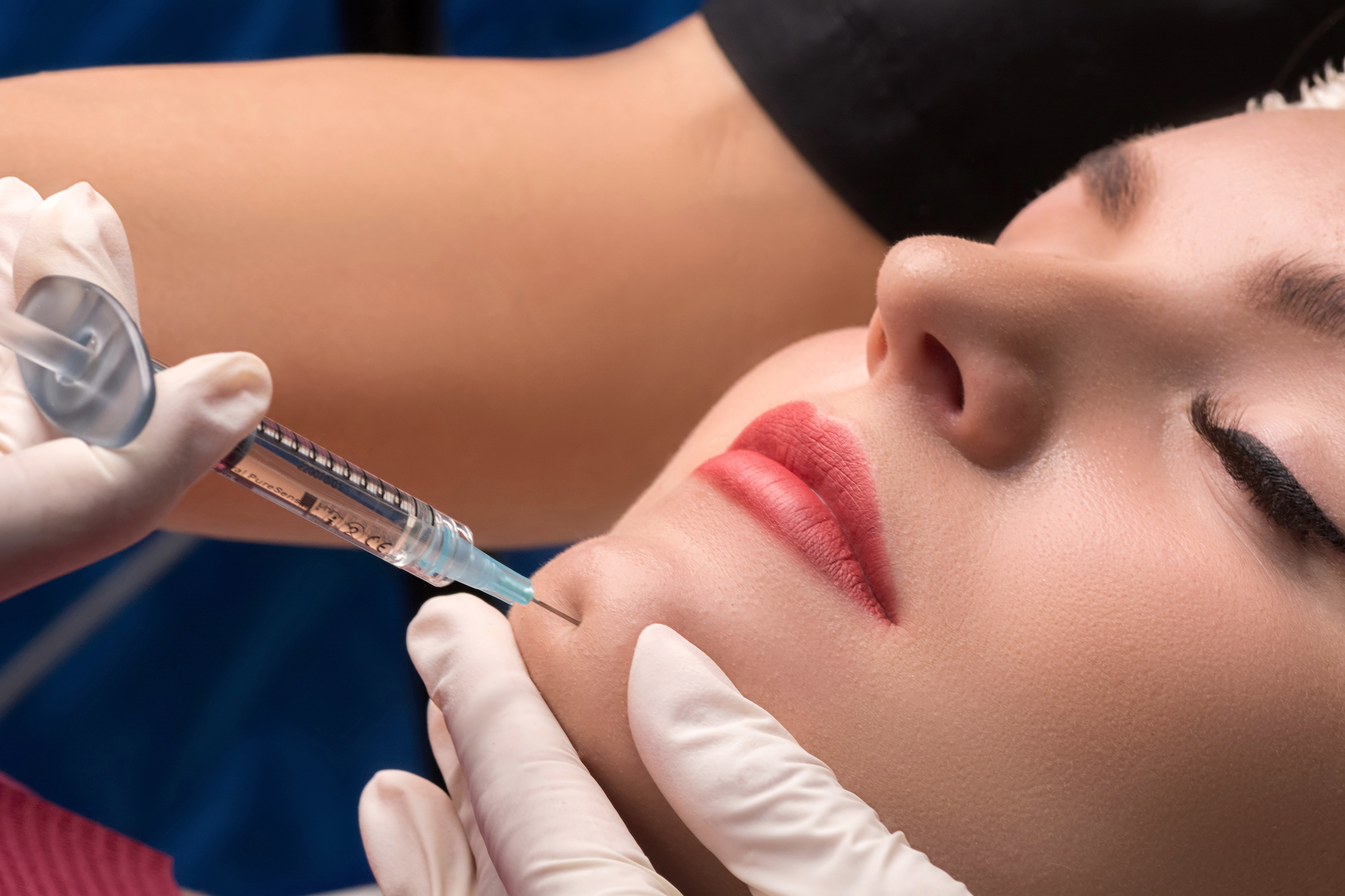 lipofilling kin lipofilling kin